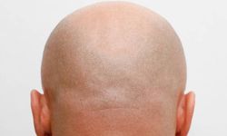 Saç dökülmesine karşı bin yıllık bitkiden yeni umut: Kellik tarih olabilir!