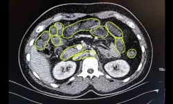 Mide ve bağırsaklarından 'zehir' çıktı!