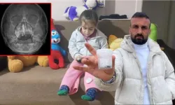 5 yaşındaki Polen'in burnundan tırnak makası zinciri çıktı!