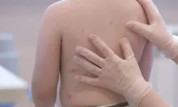 Kızamıkta 'sinsi' tehlike: Yıllar sonra gelen ölümcül riske dikkat!