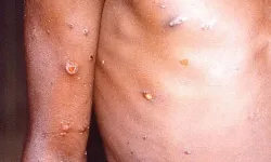 Gana'da M çiçeği vaka sayısı 1062'ye yükseldi