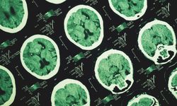 Alzheimer'ın izleri unutkanlıktan yıllar önce başlayabiliyor