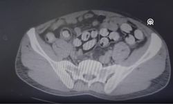 Midesinden 1 kilo 159 gram uyuşturucu çıktı!