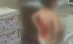 Akran zulmü: Çocuğun sırtını kolonya ile yaktılar!