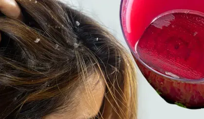 Kepeğin kalıcı çözümü manavda saklıymış: İşte sağlıklı formül!