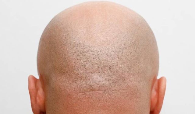 Saç dökülmesine karşı bin yıllık bitkiden yeni umut: Kellik tarih olabilir!