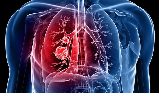 Uzmanından tüberküloz uyarısı: Tedavi yarım bırakılmamalı!