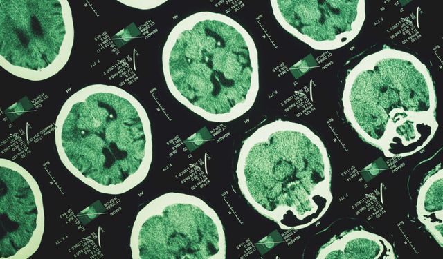 Alzheimer'ın izleri unutkanlıktan yıllar önce başlayabiliyor