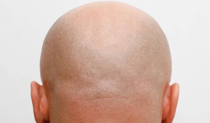 Saç dökülmesine karşı bin yıllık bitkiden yeni umut: Kellik tarih olabilir!