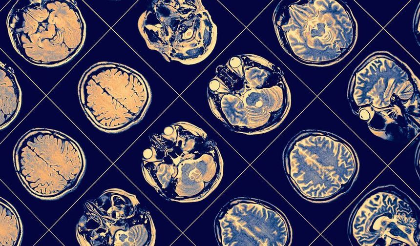 Alzheimer tanısında kan testi dönemi!