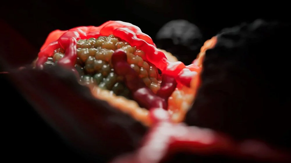 Pankreas kanseri riskini artıran 5 besin: DNA hasarına da yol açıyor